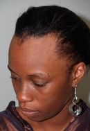 Paciente 7 Antes del Adelanto de Línea Capilar 1, Miami, FL