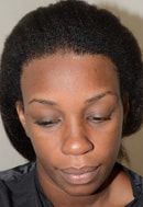 Paciente 7 Después del Adelanto de Línea Capilar, Miami, FL