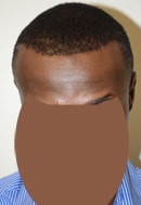 Paciente 5 Después del Adelanto de la Línea Capilar, Miami, FL