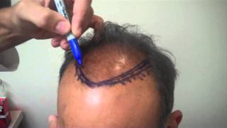 FUE Procedure