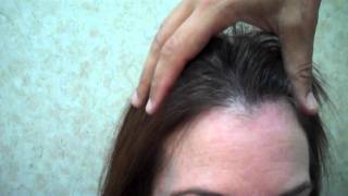 Hair Transplant Procedure 11 months post-op – Female Patient