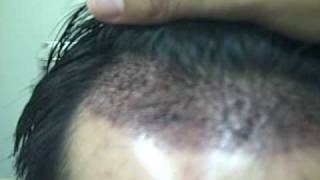 Plastic surgeon Dr Jeffrey Epstein hair transplant patient 1 day post-op