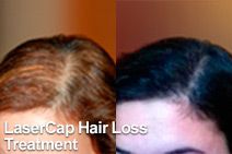Tratamiento para la Pérdida de Cabello LaserCap