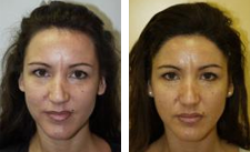 Hairline Advancement