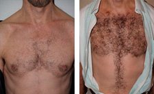 Body Hair Transplants