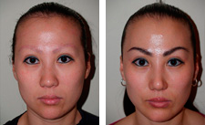Eyebrow Transplants