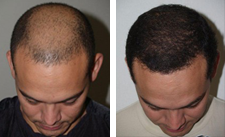 Hair Transplants for Men