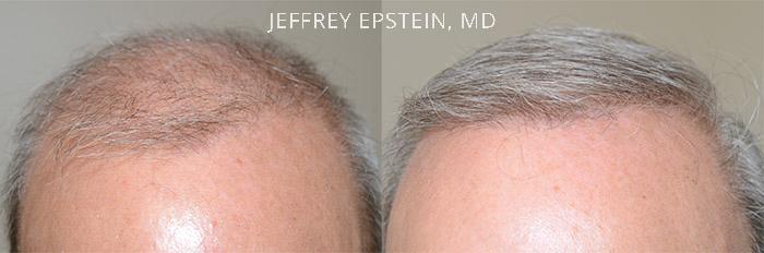 Reparación Capilar Before and after in Miami, FL, Paciente 75653