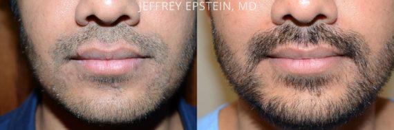 Trasplante de Pelo Facial Before and after in Miami, FL, Paciente 71216