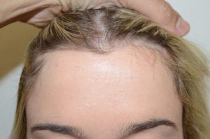 Paciente 54163 Después del Adelanto de Línea Capilar, Miami, FL