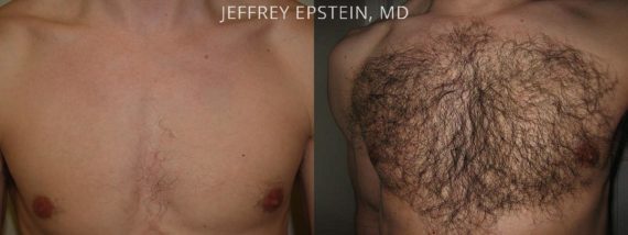 Trasplante de Pelo Corporal Before and after in Miami, FL, Paciente 61890