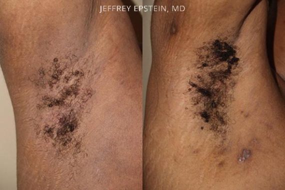 Body Hair Transplant Before and after in Miami, FL, Paciente 35146