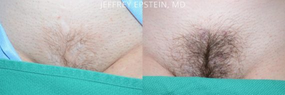 Trasplante de Pelo Corporal Before and after in Miami, FL, Paciente 61431