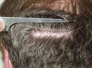 Donor Site Transplant Close Ups Before and after in Miami, FL, Paciente 35314