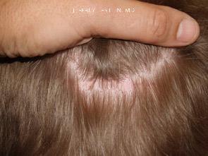 Donor Site Transplant Close Ups Before and after in Miami, FL, Paciente 35316