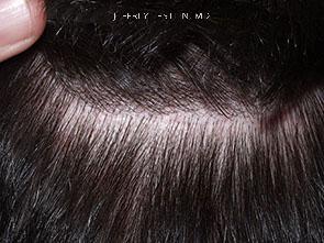 Donor Site Transplant Close Ups Before and after in Miami, FL, Paciente 35318