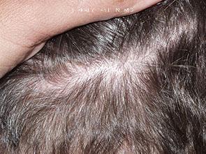 Donor Site Transplant Close Ups Before and after in Miami, FL, Paciente 35322