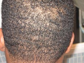 Donor Site Transplant Close Ups Before and after in Miami, FL, Paciente 35630