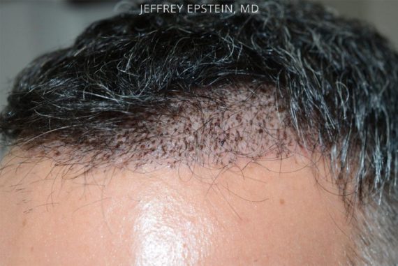 Donor Site Transplant Close Ups Before and after in Miami, FL, Paciente 35651