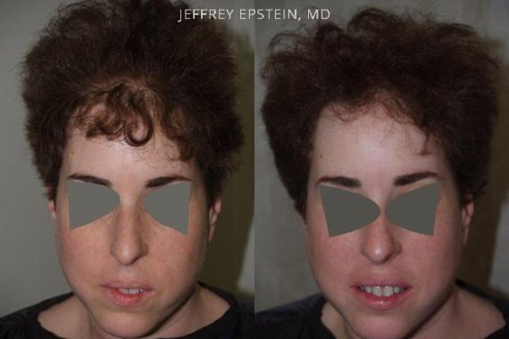 Trasplante de Pelo en Mujeres Before and after in Miami, FL, Paciente 96540