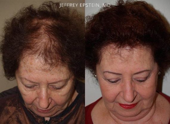 Trasplante de Pelo en Mujeres Before and after in Miami, FL, Paciente 102805