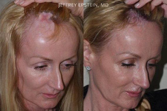 Casos Especiales Before and after in Miami, FL, Paciente 99932