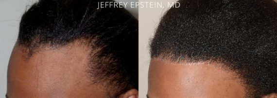 Adelanto de Línea Capilar Before and after in Miami, FL, Paciente 91339