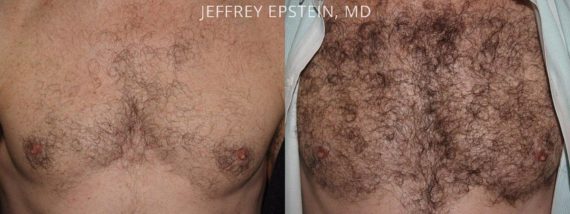 Trasplante de Pelo Corporal Before and after in Miami, FL, Paciente 61913