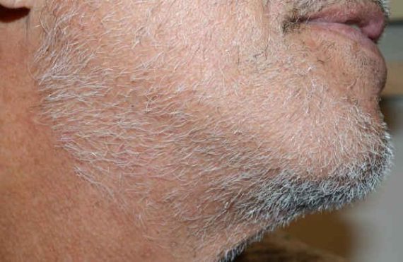 Donor Site Transplant Close Ups Before and after in Miami, FL, Paciente 58273