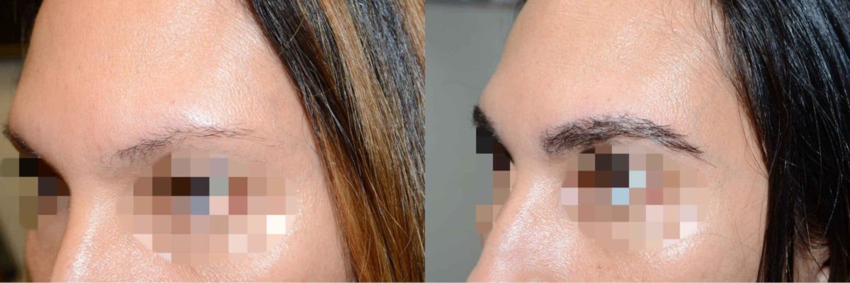 Trasplante de Pelo en Mujeres Antes y después en Miami, FL, Paciente 98822