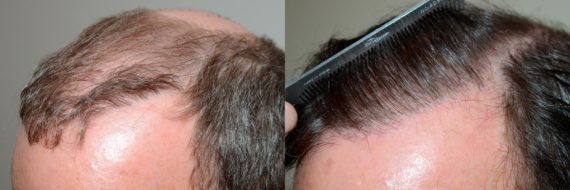 Trasplante de Pelo Corporal Before and after in Miami, FL, Paciente 61375