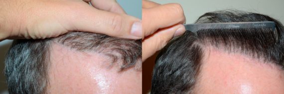 Trasplante de Pelo Corporal Before and after in Miami, FL, Paciente 61375