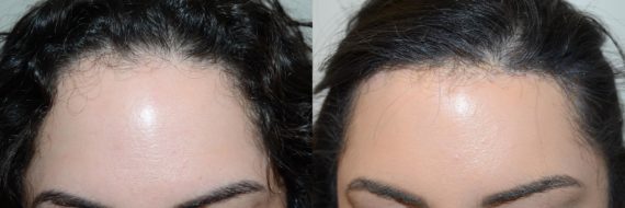 Adelanto de Línea Capilar Before and after in Miami, FL, Paciente 91065