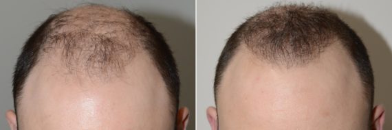 Trasplante de Pelo Corporal Before and after in Miami, FL, Paciente 61345