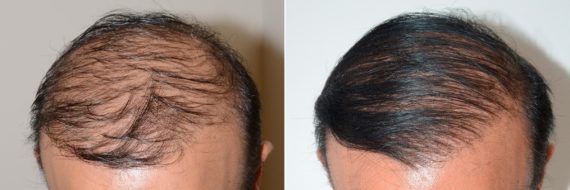 Trasplante de Pelo Corporal Before and after in Miami, FL, Paciente 61309