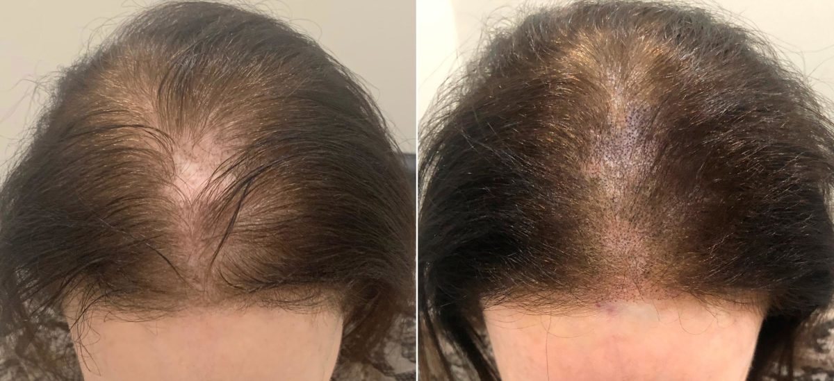 Scalp Micropigmentation Before and after in Miami, FL, Paciente 59751