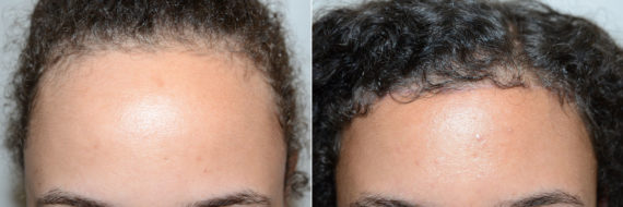Trasplante de Pelo en Mujeres Before and after in Miami, FL, Paciente 98567