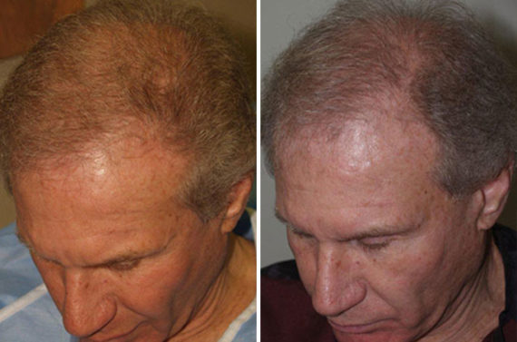 Reparación Capilar Before and after in Miami, FL, Paciente 87881