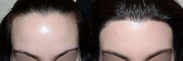 Paciente antes del Adelanto de Línea Capilar, Miami, FL