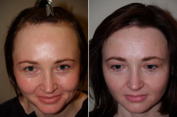 Trasplante de Pelo en Mujeres Before and after in Miami, FL, Paciente 102959