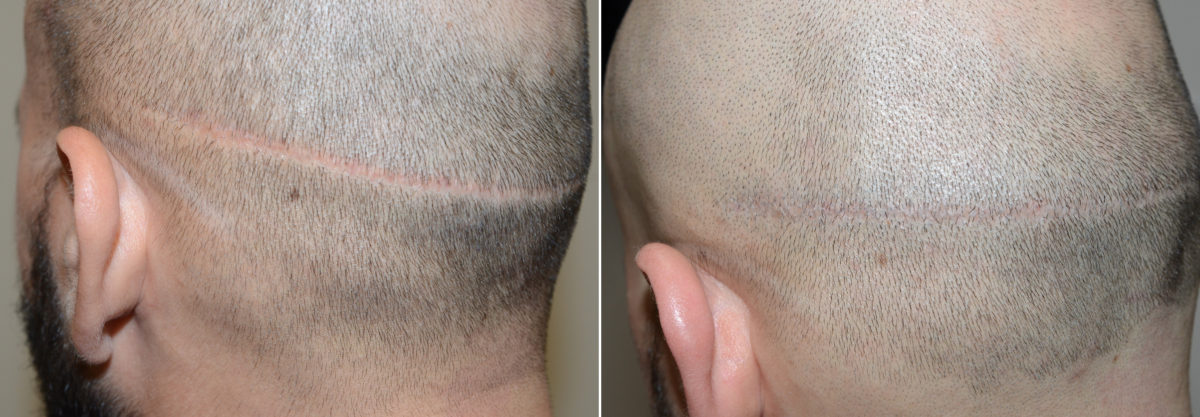 Reparación Capilar Antes y después en Miami, FL, Paciente 108186