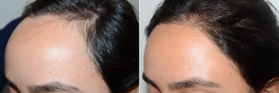 Adelanto de Línea Capilar Before and after in Miami, FL, Paciente 108677