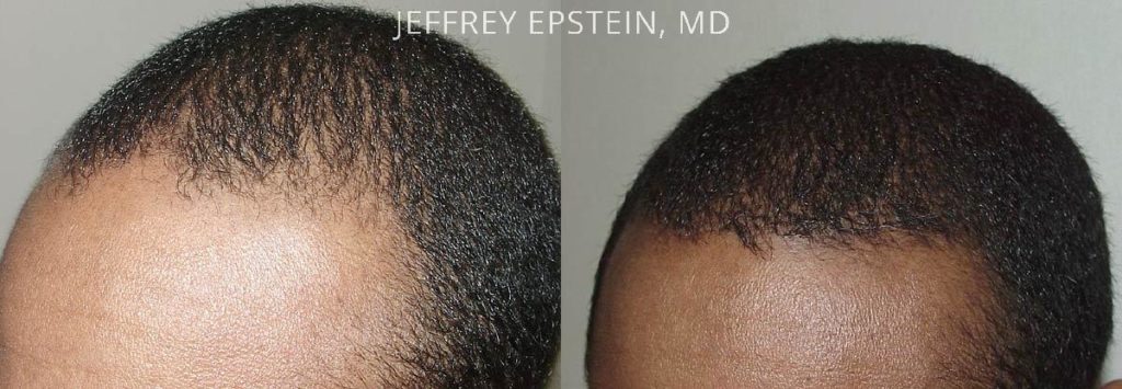 Before and six months after one FUM procedure of 1,800 grafts to fill in thinning hair.