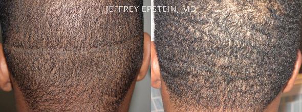 Before and after one FUE procedure of 400 grafts into the prior donor site linear scar. Dr. Epstein was able to repair the visible scar left from a previous transplant