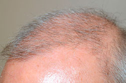 Trasplantando más de 3000 pelos de la espalda de un paciente masculino, el Dr. Epstein fue capaz de lograr a sólo 8 meses - vista de oblicue Antes