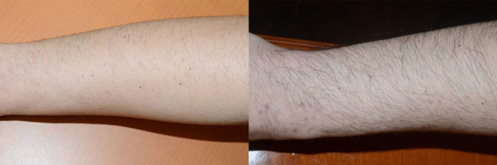 Antes y un año después de 300 injertos en cada antebrazo. Los injertos provenían del cuero cabelludo mediante la técnica FUE.