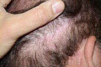 Vista posterior del Antes de BHT desde el tórax trasplantado a una cicatriz en el sitio donante antiguo, con una cicatriz mínima detectable del tórax después de la curación