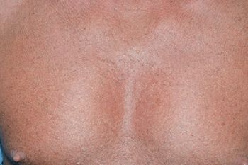 Vista del Después del pecho BHT desde el pecho trasplantado a una cicatriz en el sitio del donante antiguo, con una cicatriz mínima detectable del tórax después de la curación