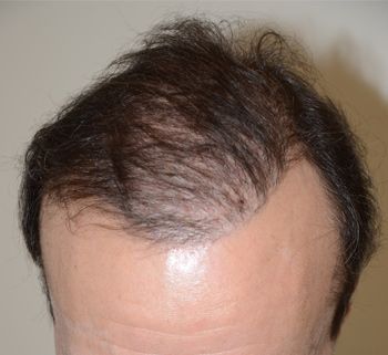 Antes de ver el procedimiento reparador BHT utilizando pelos de donantes de tórax y barba