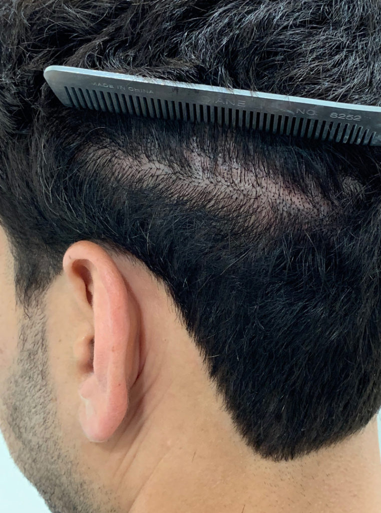 SMP - scalp micropigmentation - used to improve the appearance of a prior widened linear donor site scar back after view